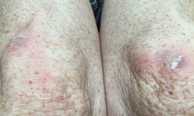 I am what I am–a Klutz of the first magnitude